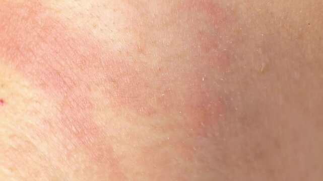 Detailed view of irritated skin with redness and inflammation. Emphasizes the importance of dermatology and proper skincare.