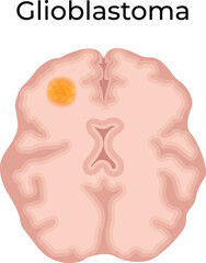 Glioblastoma Brain Tumor Vector Illustration