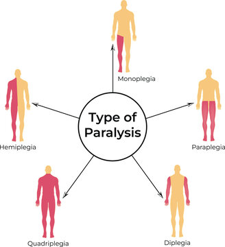Types of Paralysis Hemiplegia Monoplegia Quadriplegia Paraplegia and Diplegia Vector Illustration