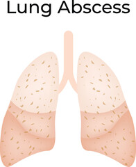Lung Abscess An Illustration of a Pulmonary Infection