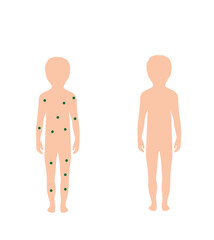 the body of a healthy child and the body of a child with chickenpox,