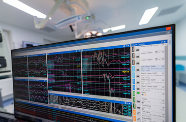 Surgery vital signs monitored. Advanced monitoring equipment displays real-time vital signs in a modern surgical room during an ongoing procedure.