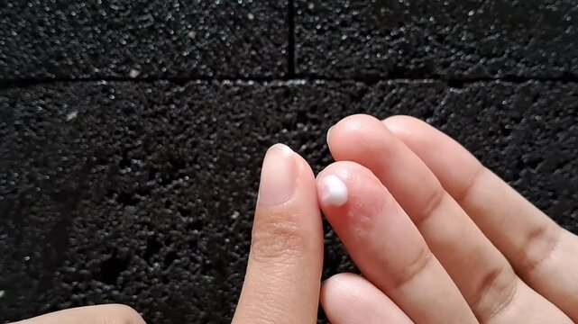 Applying moisturizer on the inflamed and itchy skin because of dyshidrotic dermatitis (Pompholyx)