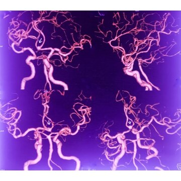 MRI of brain and MRA. CT Angiogram Brain showing anterior communicatting artery small dilatation, saccular aneurism. Hypoplasia of A1 segment. Cerebral atrophy.