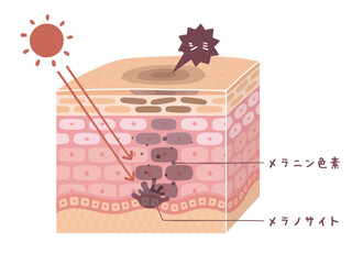 肌の断面図で見るシミが出来る図解イラスト