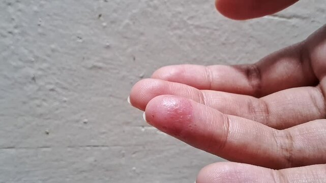 Atopic dermatitis and dyshidrotic eczema on ring finger