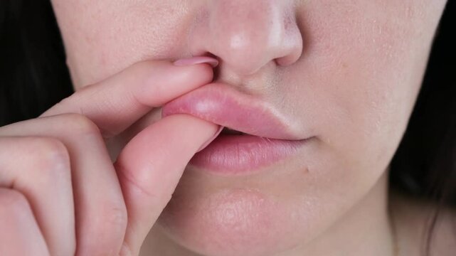 The woman made lip augmentation. The gel went beyond the lip. Migration of the filler into the circular muscle of the mouth