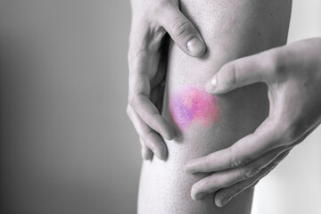 Large bruise on the knee