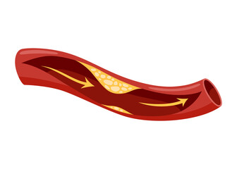 Atherosclerosis stage. Anatomy of heart attack. Arteriosclerotic vascular disease or ASVD. Atherosclerotic plaque in coronary artery. illustration on white background