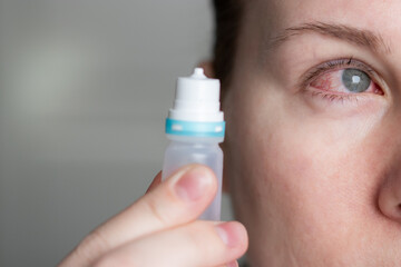 Close up of a woman applying eyedrops on red infected eye with conjunctivitis at home