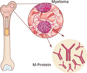 Myeloma residing in the bone marrow illustration. vector illustration of Myeloma cancer producing M-protein
