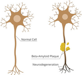 Normal cell vs neuron affected by neurodegeneration. Pathophysiology of Alzheimer's disease, with amyloid plaques damaging neural cell vector