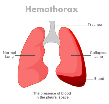 Hemothorax, blood in the lungs. Blood collects in pleural cavity. Lungs collapse, failure and disorder, respiratory system diseases.  Vector illustration