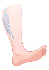 Varicose veins. Blue blood vessel visible through the skin, abnormally swollen leg. Vascular disease diagnostic and treatment. Venous insufficiency medical disease