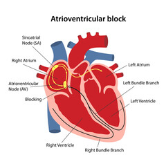 Atrioventricular block. Image of human heart with cardiac conduction system diagram with main captions. Vector illustration in flat style isolated on white background