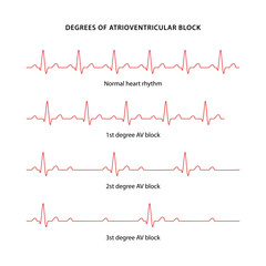 Normal rhythm and three degrees of AV block diagram for human heart. Cardiogram of heart. Vector illustration in flat style isolated on white background