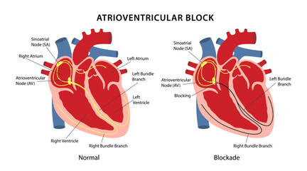 Atrioventricular block. Image of healthy heart and diseased human heart. Cardiac conduction system diagram with main captions. Vector illustration in flat style isolated on white background