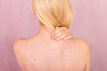 Skin health awareness highlighting back examination for cancer