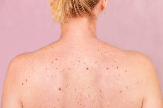 Awareness of Skin Health and Cancer Prevention Importance