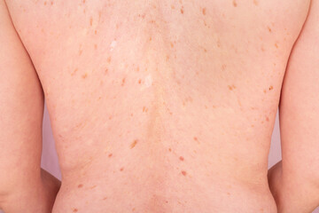 Skin cancer awareness and prevention health education