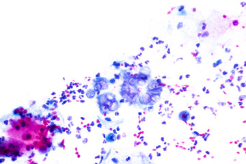Genital herpes infection by the herpes simplex virus (HSV) of the genitals.Ground glass appearance...