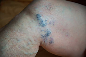 Varicose veins on the leg of an elderly woman, close-up. Healthcare concept