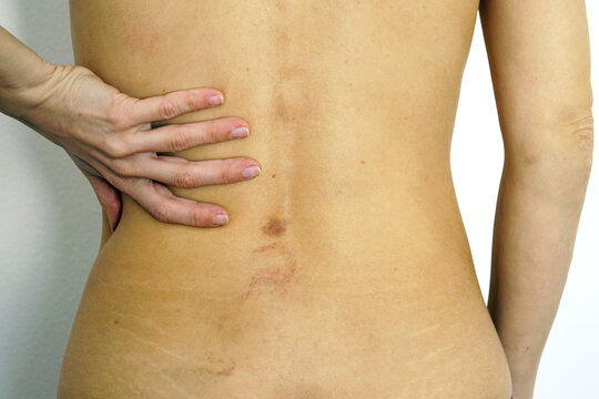 A close-up photo of a woman's back with a bruise. Minor injuries: the woman holds her hand near the place where the mark from the blow remained on the skin. Stretch marks and hematomas on the body.