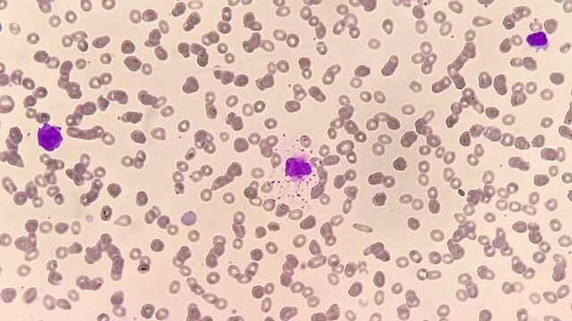Photomicrographic footage showing Marginal Zone Lymphoma with thrombocytopenia, a rare type of non-Hodgkin lymphoma