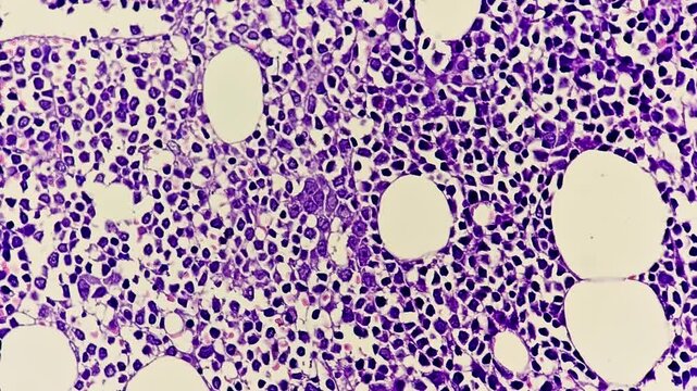 Microscopic footage of Trephine Biopsy showing Acute Leukemia, Bone marrow biopsy