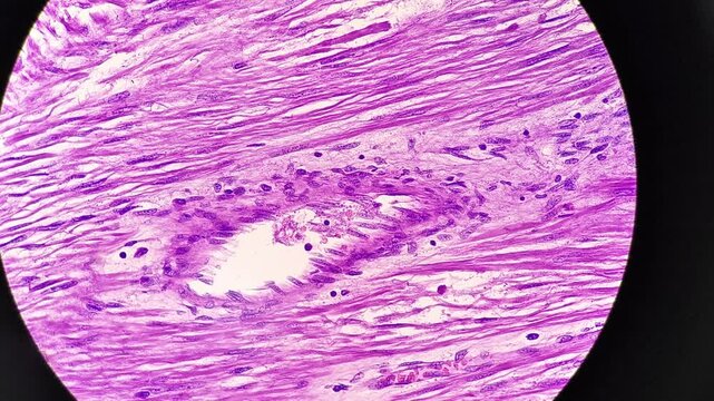 Microscopic footage of gastrointestinal stromal tumor (GIST), a rare type of cancer that begins in the digestive system.
