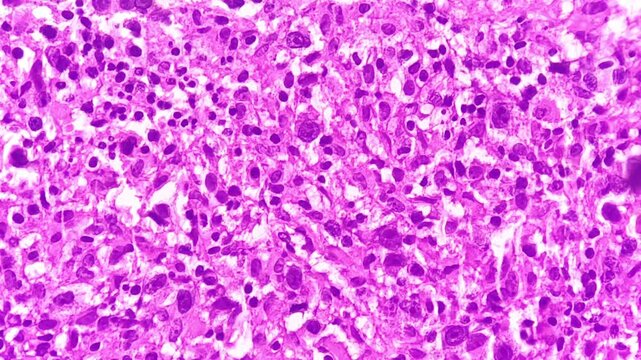 Mixed cellularity classic Hodgkin lymphoma (MCCHL), a subtype of classic Hodgkin lymphoma characterized by Hodgkin, Reed Sternberg cells in a diffuse mixed inflammatory background