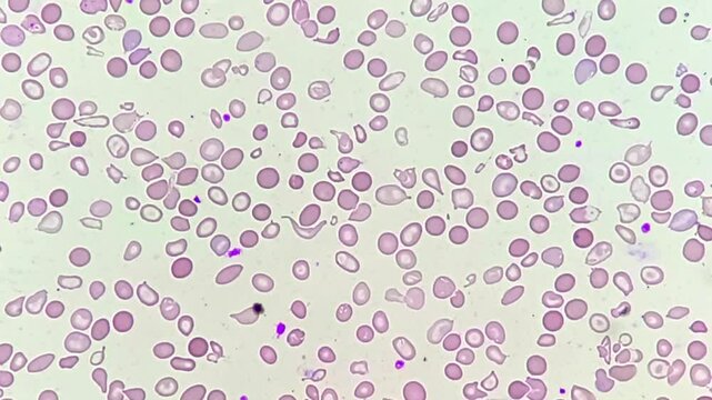 Hematological slide of Microscopic image showing severe microcytic hypochromic anemia. Tear drop cell and others abnormal RBC present