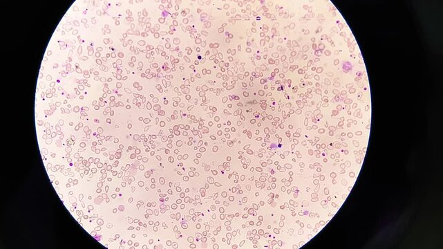 Hematological slide of Microscopic footage showing severe microcytic hypochromic anemia. Tear drop cell and others abnormal RBC present