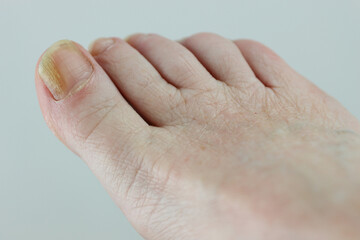 close up of a foot with toenail fungus on the big toe