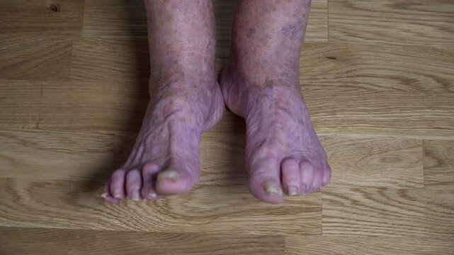 Sick elderly leg. Senior leg problems. Legs old woman with crippled nails. Toenail fungus on senior female toes close up. Unkempt crone toenails. Calluses and sores on legs. Pain and discomfort feet.