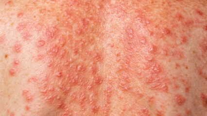 Fototapeta premium Close-Up View of Skin Condition with Red Bumps on Adult Back in Natural Light