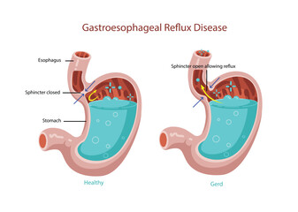 Gastroesophageal Reflux Disease