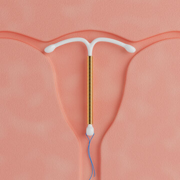 Birth Control Concept. T Shape IUD Copper Intrauterine Device Inside the Uterus. 3d Rendering
