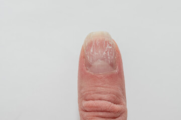 Close-up of a damaged fingernail with peeling and brittle surface on a white background. Concept of nail health, injury, and care. consequences of vitamin and mineral deficiencies