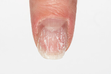Close-up of a damaged fingernail with peeling and brittle surface on a white background. Concept of nail health, injury, and care. Mechanical nail damage. bad habits. nail health on hormonal balance