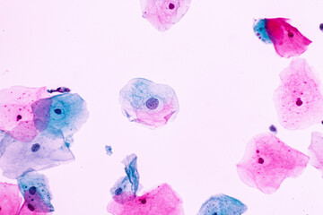 Abnormal squamous epithelial cells on white background view in microscopy.Atypical epithelial cells...