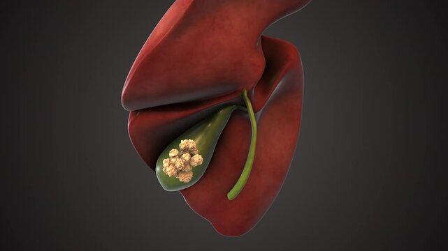 Medical animation of gallbladder stones