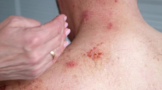A woman applies medicinal ointment to her husband's affected with shingles or Herpes zoster skin. Viral disease Varicella virus. Painful skin rash and pimples. Sun body burn. High quality 4k footage.