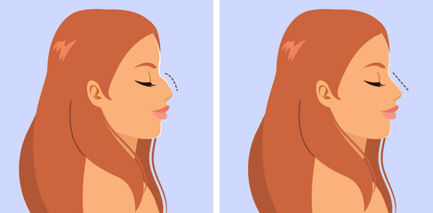 Detailed cartoon illustration showing woman nose profile before and after rhinoplasty surgery. Drawing for cosmetic surgery clinics, beauty blogs, health-related content