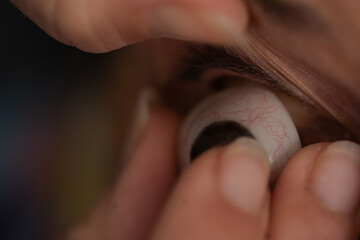 Ocularist placing an ocular prosthesis in patient's eye socket