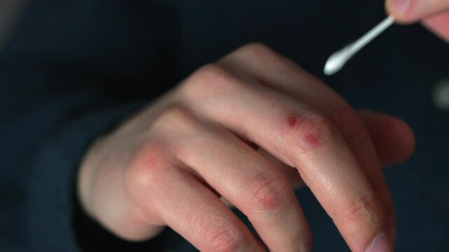 A man treats an injured hand with a cotton swab.
Close-up of a cotton swab.
Antibacterial procedures.
Hand injury