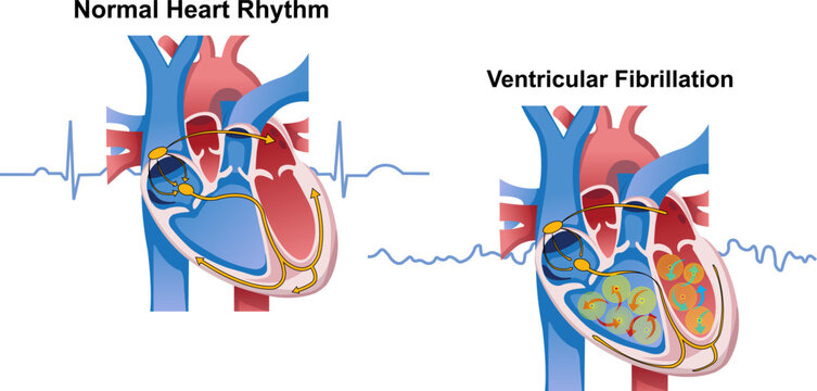 Normal heart rhythm vs ventricular fibrillation