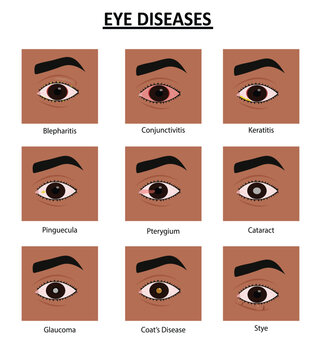 Eye diseases vector illustration