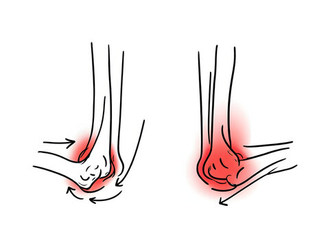 comparing healthy elbow to inflamed olecranon bursa, showing the effects of bursitis on the elbow joint diagram hand drawn schematic raster illustration.