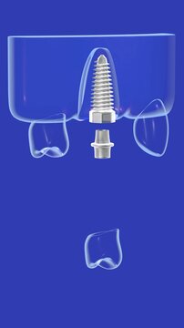 3D animation of a dental implant in a mixed, realistic, and transparent graphic style. In two phases, before and after placement. Placed in the glass gum on a blue background, showing the interior.